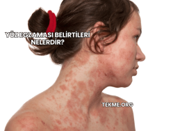 Yüz Egzaması Belirtileri Nelerdir?