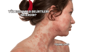 Yüz Egzaması Belirtileri Nelerdir?