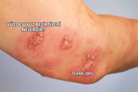 Yüzde Uyuz Belirtileri Nelerdir?