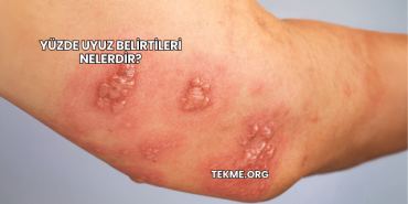 Yüzde Uyuz Belirtileri Nelerdir?