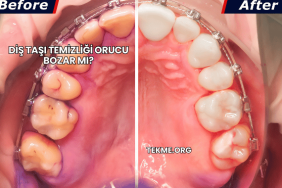 Diş Taşı Temizliği Orucu Bozar mı?