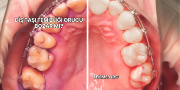 Diş Taşı Temizliği Orucu Bozar mı?