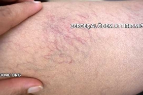 Zerdeçal Ödem Attırır mı?