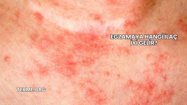 Egzamaya Hangi İlaç İyi Gelir?