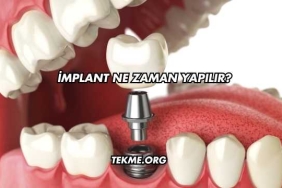 İmplant Ne Zaman Yapılır?