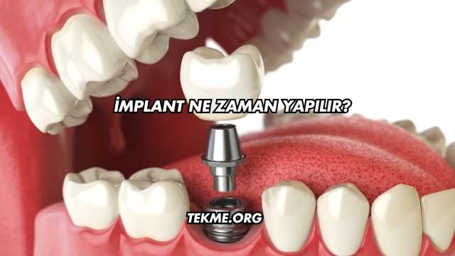 İmplant Ne Zaman Yapılır?
