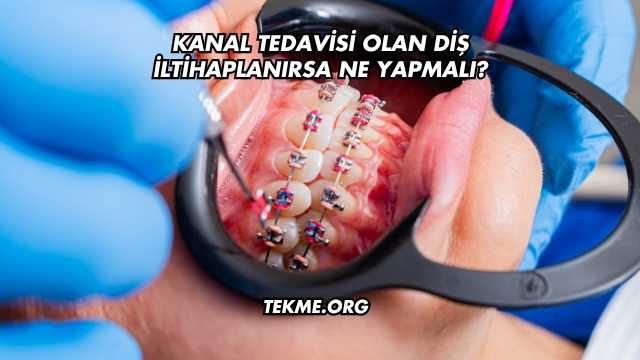 Kanal Tedavisi Olan Diş İltihaplanırsa Ne Yapmalı?