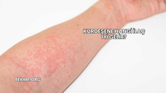 Kurdeşene Hangi İlaç İyi Gelir?