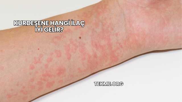 Kurdeşene Hangi İlaç İyi Gelir?