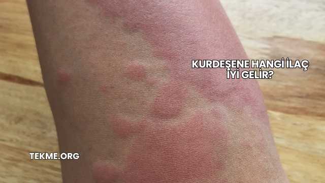 Kurdeşene Hangi İlaç İyi Gelir?