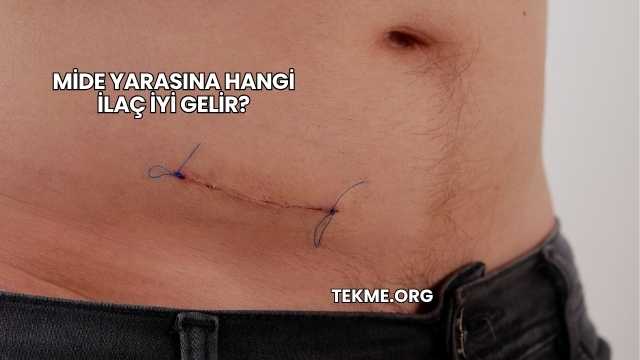 Mide Yarasına Hangi İlaç İyi Gelir?