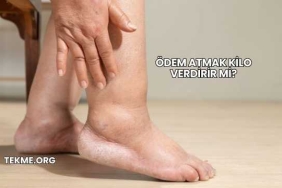 Ödem Atmak Kilo Verdirir mi?