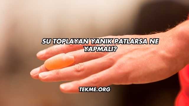 Su Toplayan Yanık Patlarsa Ne Yapmalı?