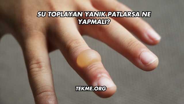 Su Toplayan Yanık Patlarsa Ne Yapmalı?