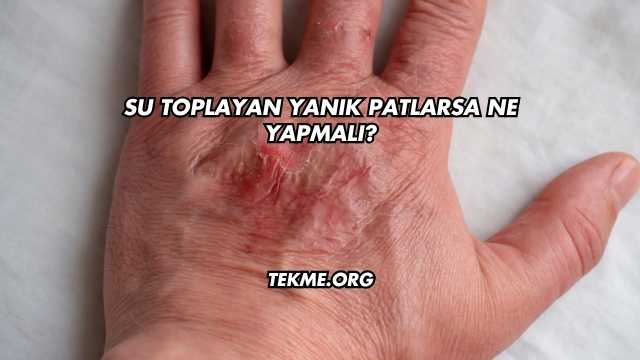 Su Toplayan Yanık Patlarsa Ne Yapmalı?