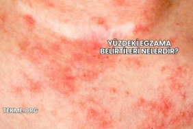 Yüzdeki Egzama Belirtileri Nelerdir?