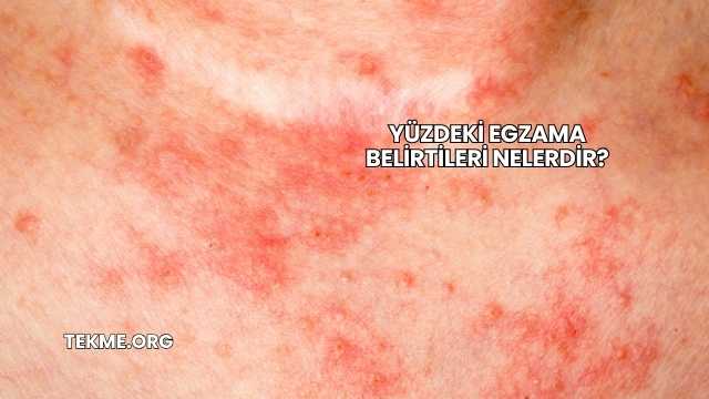 Yüzdeki Egzama Belirtileri Nelerdir?