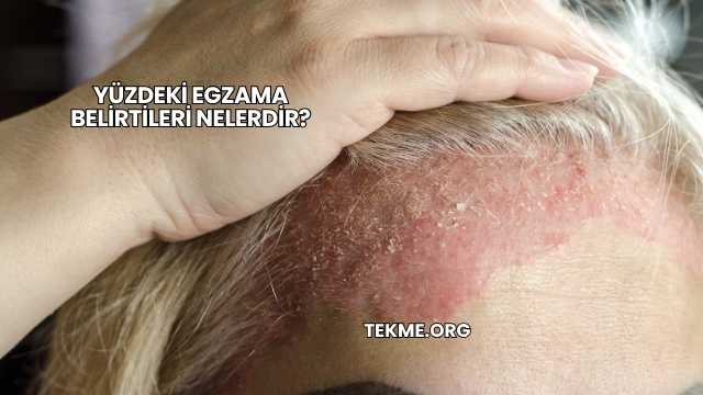 Yüzdeki Egzama Belirtileri Nelerdir?