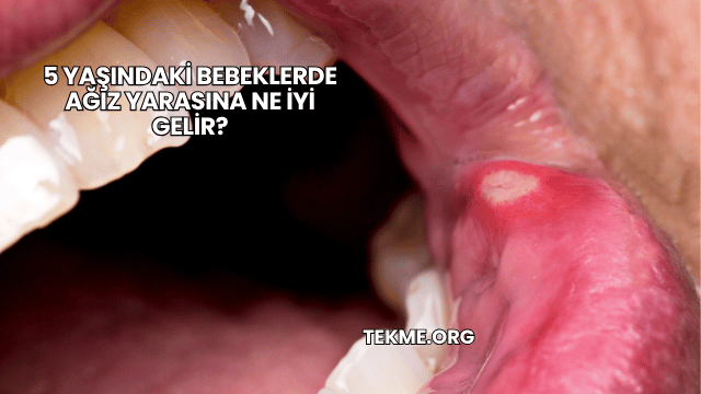 5 Yaşındaki Bebeklerde Ağız Yarasına Ne İyi Gelir?