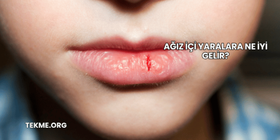 Ağız İçi Yaralara Ne İyi Gelir?