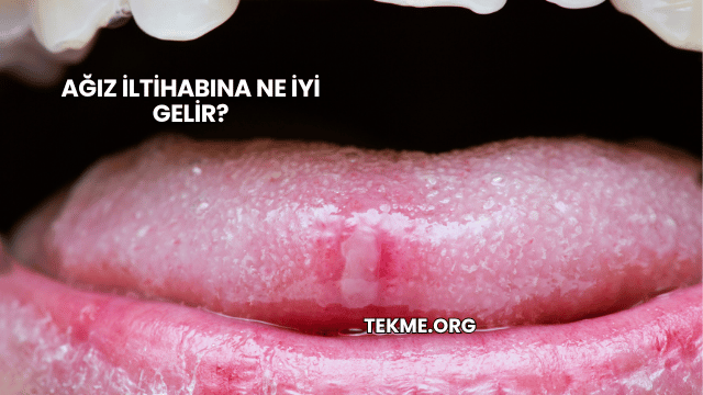Ağız İltihabına Ne İyi Gelir?
