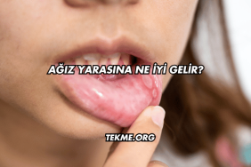Ağız Yarasına Ne İyi Gelir?