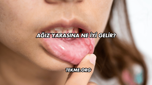 Ağız Yarasına Ne İyi Gelir?