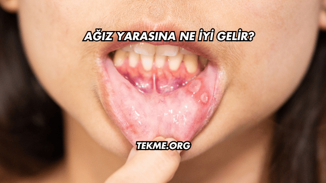 Ağız Yarasına Ne İyi Gelir?