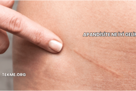 Apandisite Ne İyi Gelir?