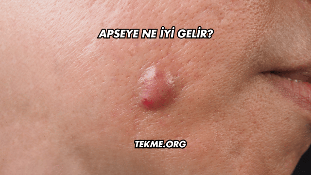 Apseye Ne İyi Gelir?