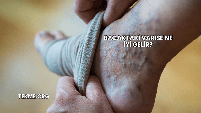 Bacaktaki Varise Ne İyi Gelir?