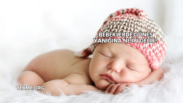 Bebeklerde Güneş Yanığına Ne İyi Gelir?
