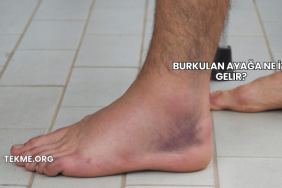 Burkulan Ayağa Ne İyi Gelir?