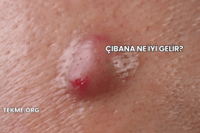 Çıbana Ne İyi Gelir?