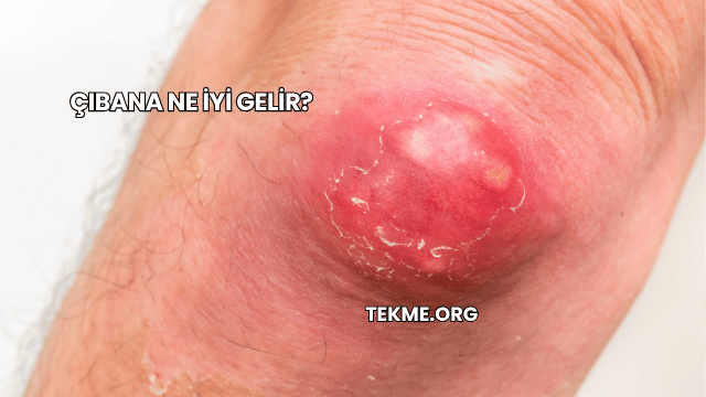 Çıbana Ne İyi Gelir?