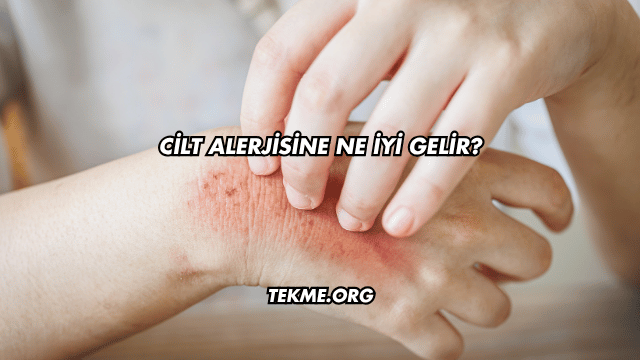 Cilt Alerjisine Ne İyi Gelir?