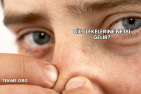 Cilt Lekelerine Ne İyi Gelir?