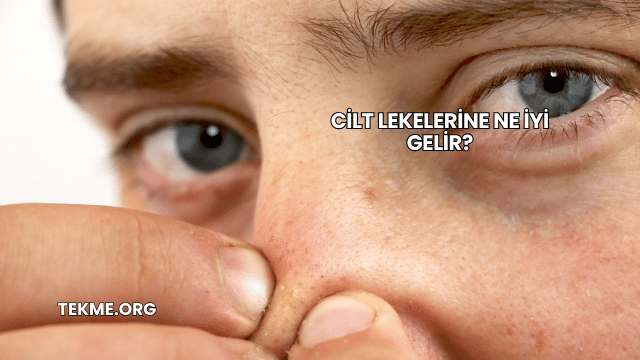 Cilt Lekelerine Ne İyi Gelir?