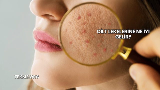Cilt Lekelerine Ne İyi Gelir?