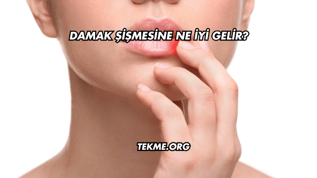 Damak Şişmesine Ne İyi Gelir?