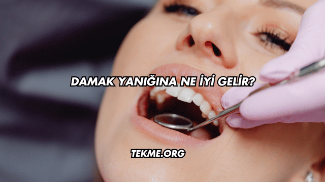 Damak Yanığına Ne İyi Gelir?