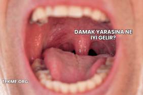 Damak Yarasına Ne İyi Gelir?