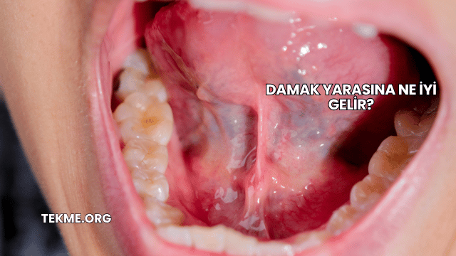 Damak Yarasına Ne İyi Gelir?
