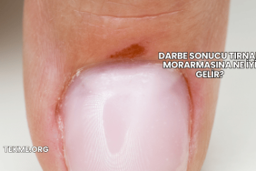 Darbe Sonucu Tırnak Morarmasına Ne İyi Gelir?