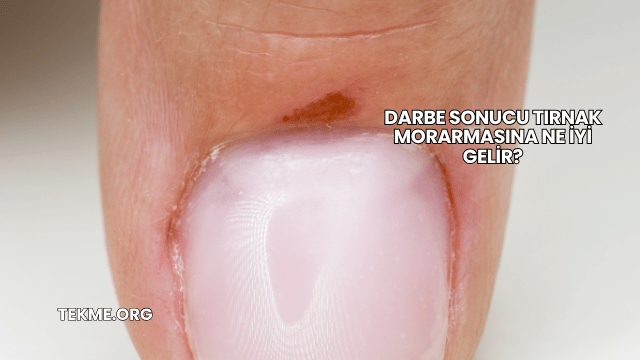 Darbe Sonucu Tırnak Morarmasına Ne İyi Gelir?