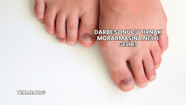 Darbe Sonucu Tırnak Morarmasına Ne İyi Gelir?