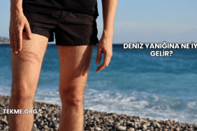 Deniz Yanığına Ne İyi Gelir?