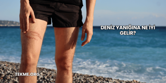 Deniz Yanığına Ne İyi Gelir?