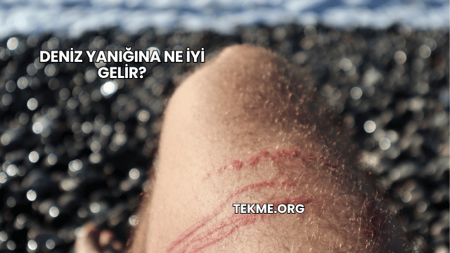 Deniz Yanığına Ne İyi Gelir?