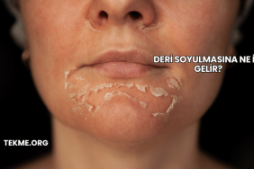 Deri Soyulmasına Ne İyi Gelir?